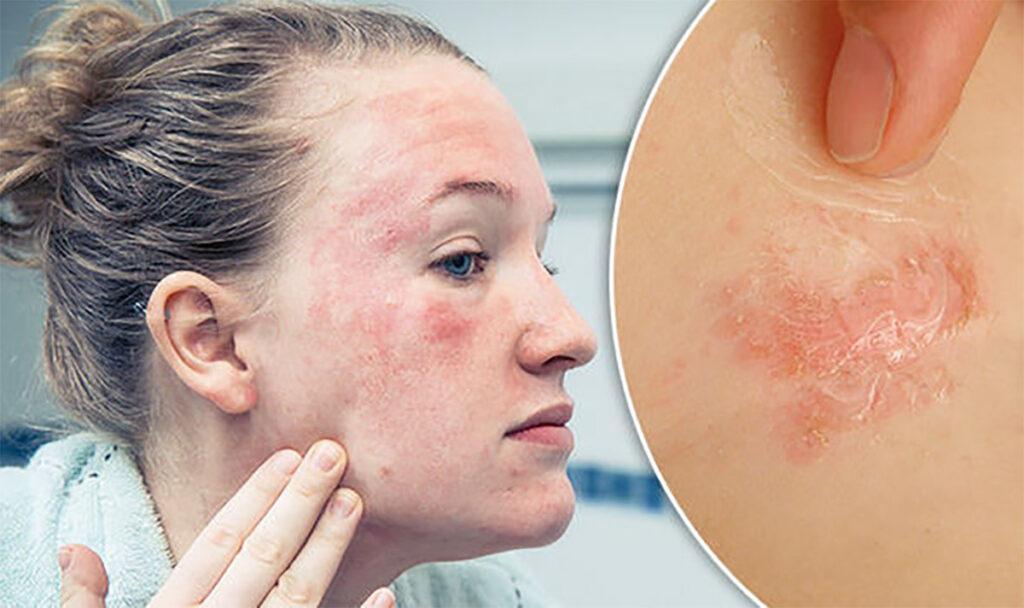 image of a woman affected with eczema